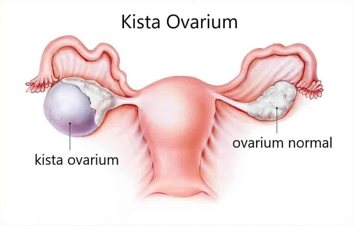 Kista Ovarium